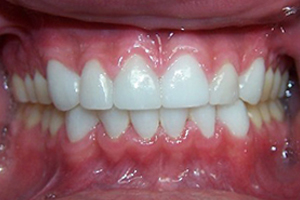 Dental Restorations After