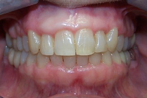 Invisalign After