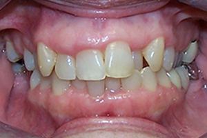 Invisalign Before