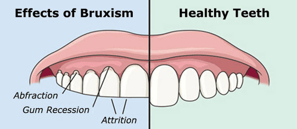 Bruxism