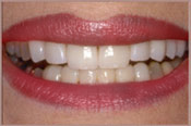 Veneers_A.jpg