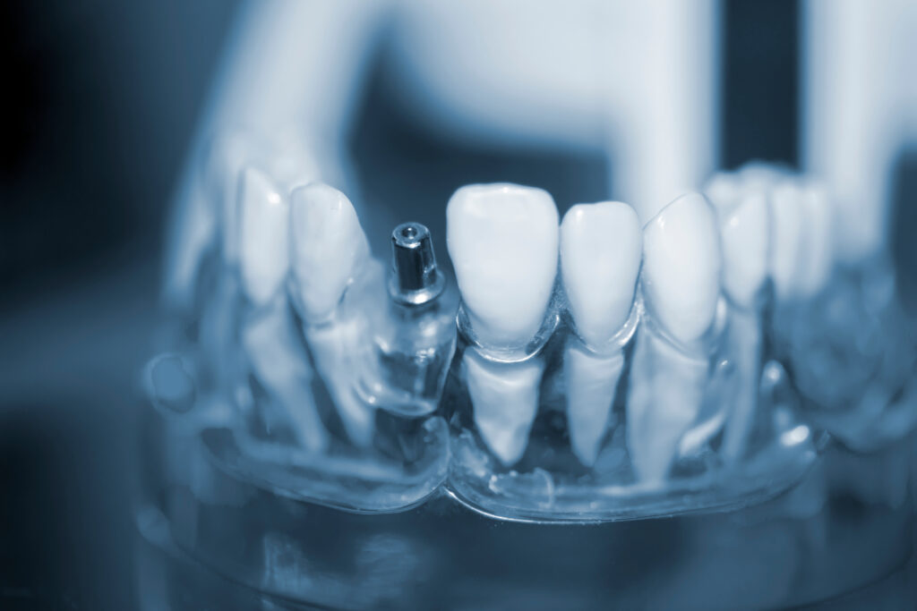 dental implant model close up, clear model